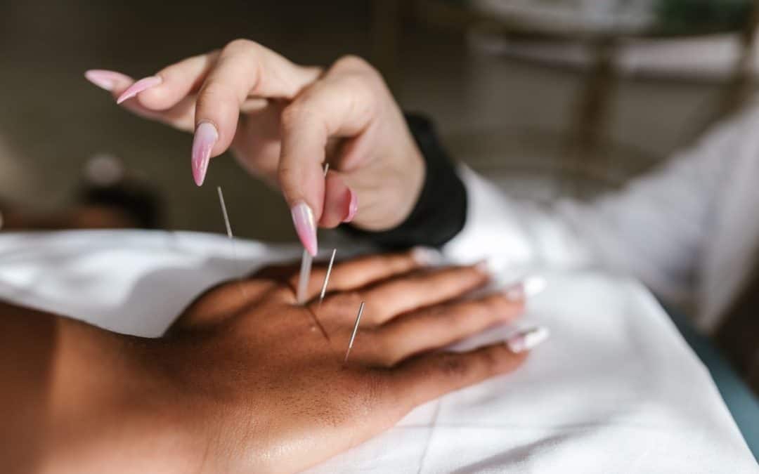What are the Benefits of Acupuncture?
