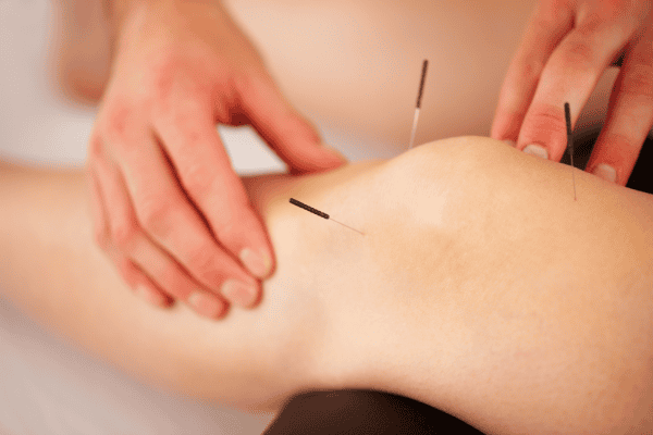 What are the Benefits of Acupuncture
