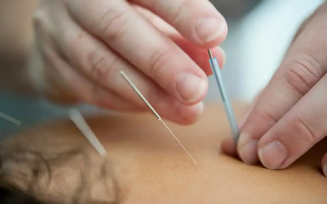 Acupuncture for Sciatica: What Patients Should Know