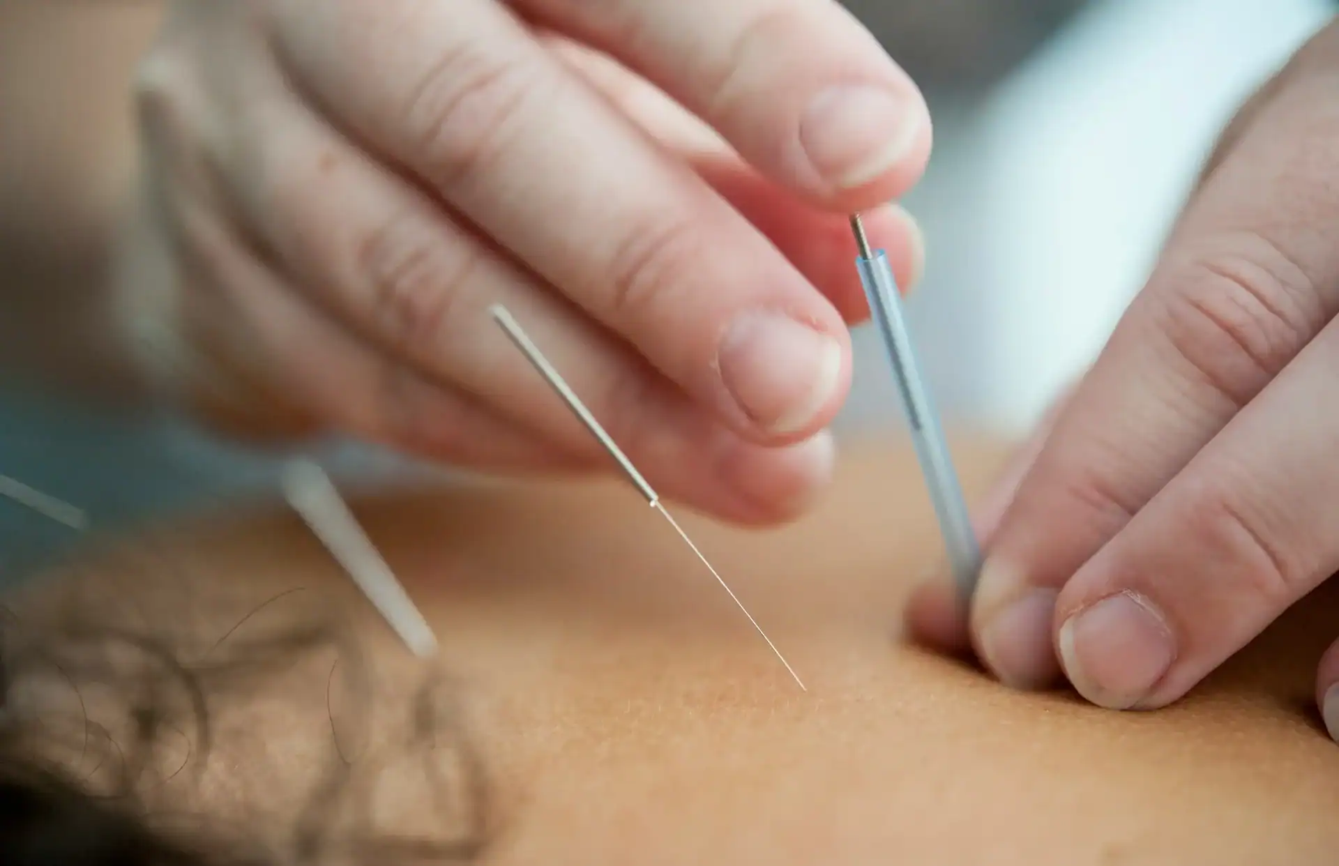 Acupuncture for Sciatica Acupuncture for Sciatica